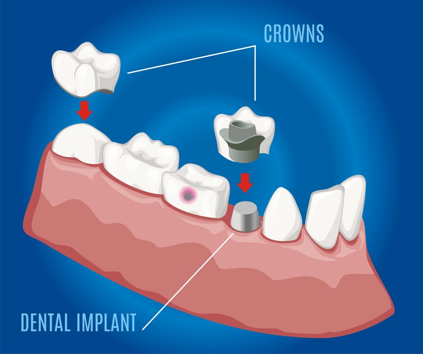 Crowns, Caps, Bridges & Dentures Treatment in Gangapur Road Nashik