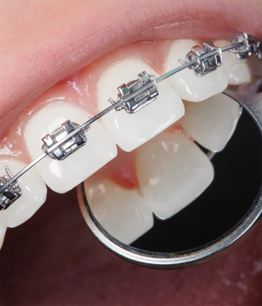 Dental Braces & Orthodontics Clinic in College Road Nashik