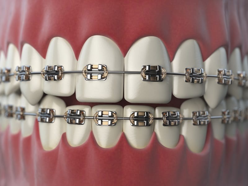 Dental Braces & Orthodontics in Mahatma Nagar Nashik