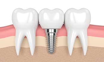 Dental Implants in Panchavati Nashik | Care 32 Dental and Implant Centre