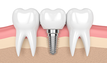 Dental Implants in Panchavati Nashik | Care 32 Dental and Implant Centre