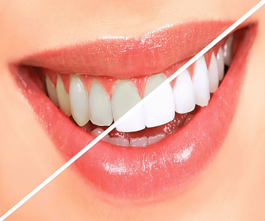 Effective Teeth Whitening Treatments in Nashik Care32 Dental