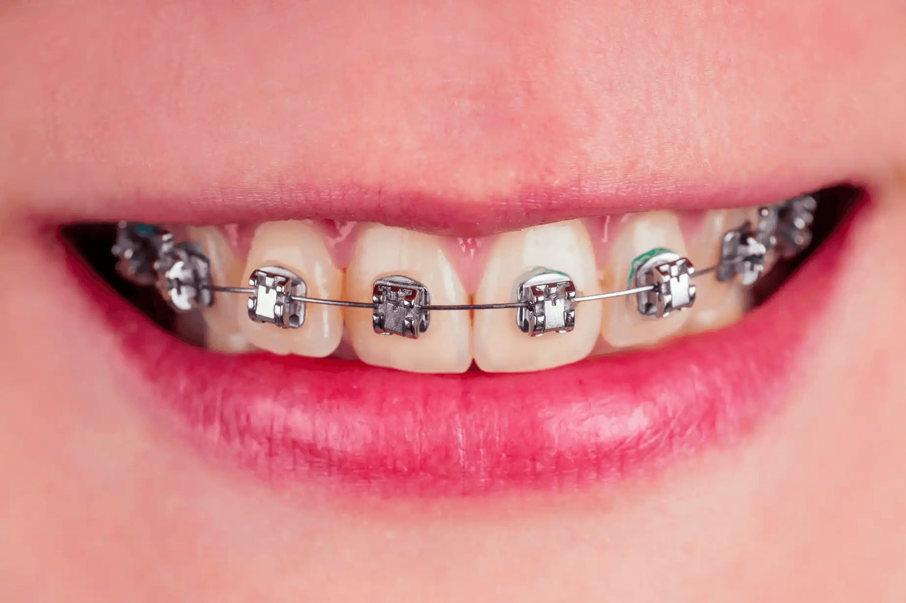 Orthodontics for Adults: Why Braces Aren’t Just for Kids