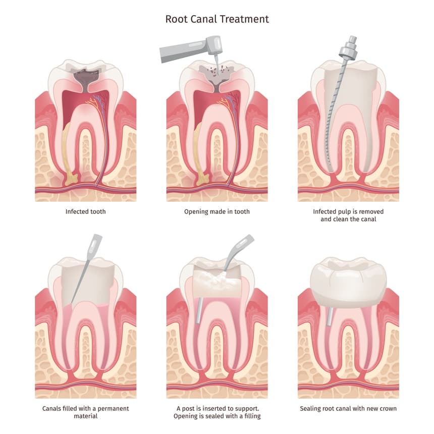 Painless Root Canal Treatment in College Road Nashik