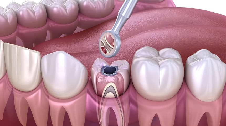 Painless Root Canal Treatment in Gangapur Road Nashik | Care 32 Clinic