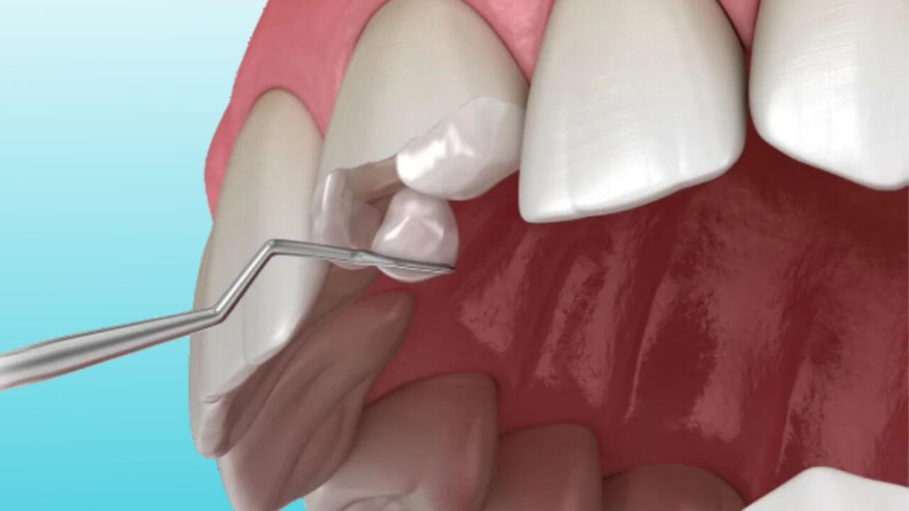 Tooth Color Fillings in Sharanpur Road Nashik