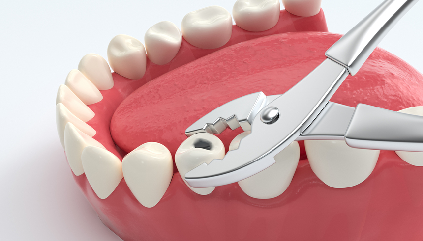 Tooth Extraction Treatment Clinic in Panchavati Nashik | Care 32 Dental