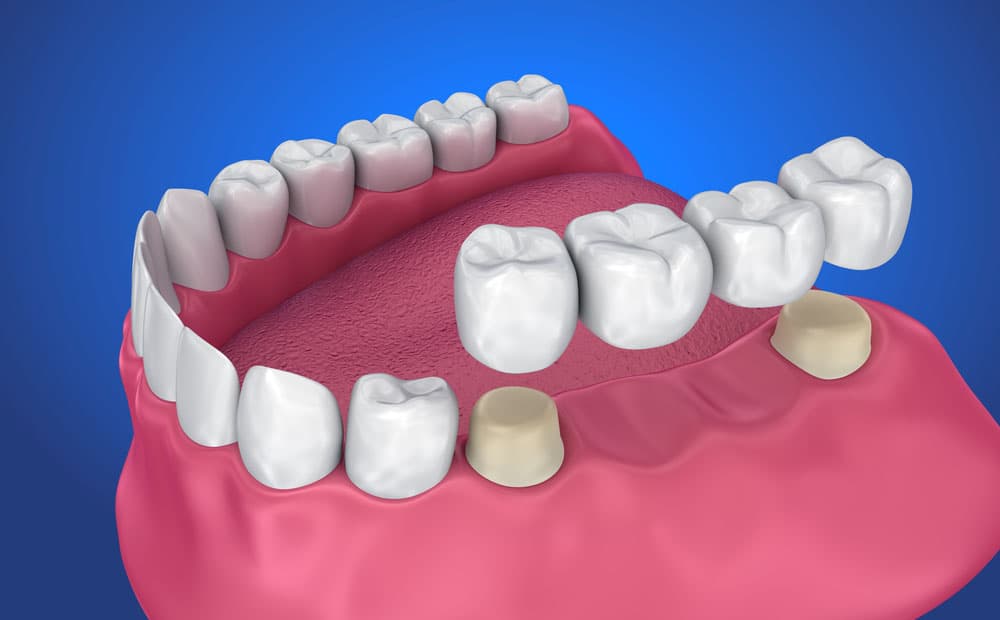 Crowns, Caps, Bridges & Dentures in Mahatma Nagar Nashik