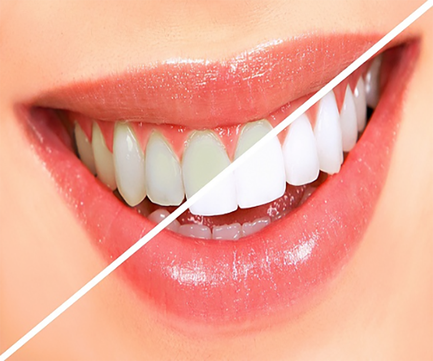 Teeth Whitening Treatment